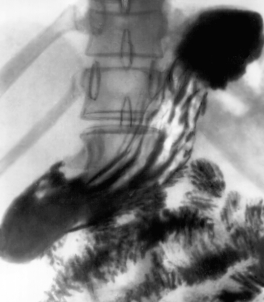 Рис. 2. Рентгенограмма желудка в норме при его обычном наполнении рентгеноконтрастным веществом