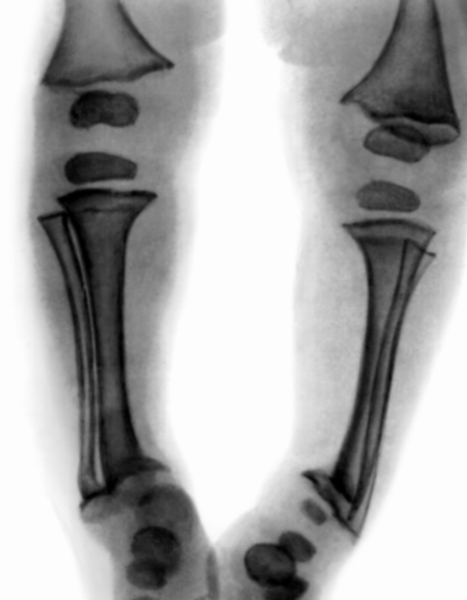 Рис. 5. Рентгенограмма нижних конечностей ребенка 1 года 5 месяцев: нечеткость костной структуры, расширены зоны предварительного обызвествления, неровный, бахромчатый субхондральный контур метафизов