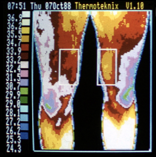 Термограмма нижних конечностей при ревматоидном артрите: повышение кожной температуры в области пораженного левого коленного сустава