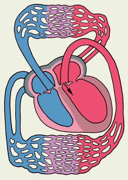 Рис. 12. Схема основных изменений сердца при недостаточности аортального клапана (обозначения те же, что на рис. 3): значительная дилатация и гипертрофия левого желудочка; стрелкой указано направление регургитации крови в диастолу