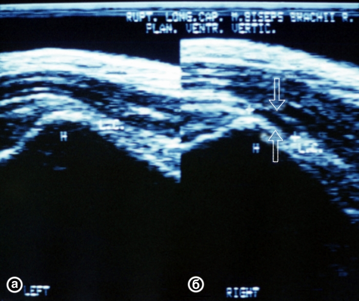 Рис. 3. Ультрасонограмма сухожилия длинной головки двуглавой мышцы плеча в норме (а) и при разрыве (б): зона разрыва указана стрелками
