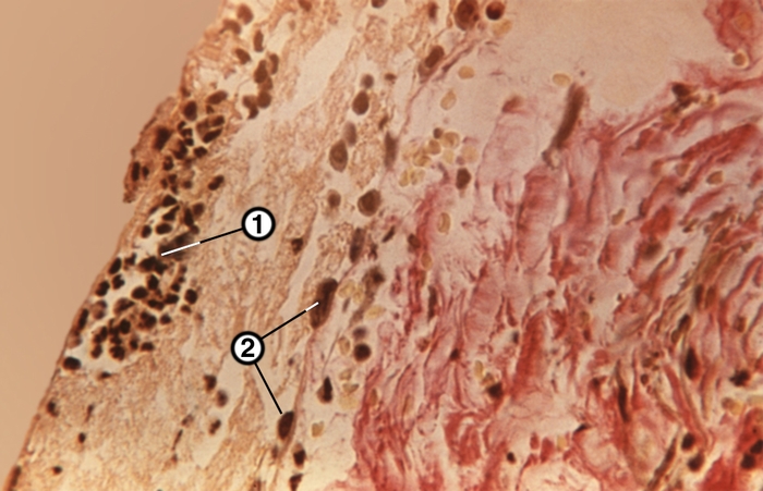 Рис. 2в). Микропрепараты париетальной и висцеральной брюшины при гнойном перитоните: фибринозно-гнойные наложения на брюшине (1), слущенные клетки мезотелия (2), окраска по Ван-Гизону; ×80