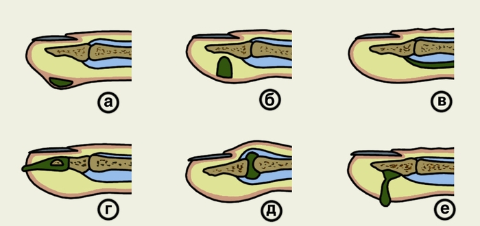 Рис. 1. Схематическое изображение различных форм панариция: а — кожный; б — подкожный; в — сухожильный; г — костный; д — суставной; е — типа «запонки»
