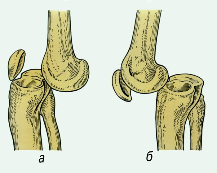 Рис. 2. Схема вывихов в коленном суставе: а — передний вывих; б — задний вывих