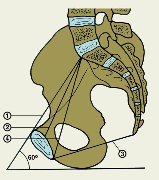 Рис. 3. Размеры женского таза на сагиттальном распиле: 1 — анатомическая конъюгата; 2 — истинная (гинекологическая) конъюгата; 3 — прямой <a href=