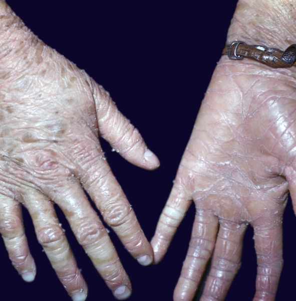 Рис. 6. Проявления ламеллярного ихтиоза: поражение кистей рук с развитием выраженных роговых наслоений на ладонях