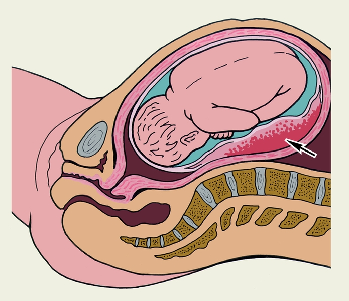 Рис. 1. Ретроплацентарная гематома (указана стрелкой) при отслойке центральной части нормально расположенной плаценты
