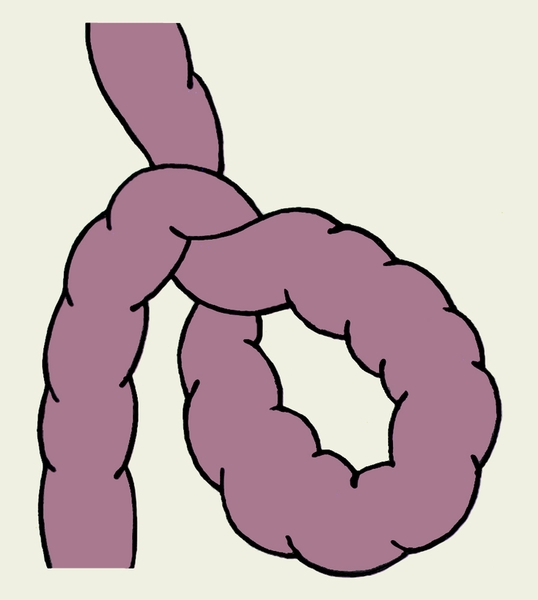 Рис. 1. Схематическое изображение заворота тонкой кишки