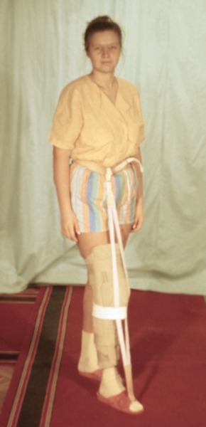 Рис. 5. Беззамковый ортез для правого коленного сустава, обеспечивающий восстановление опорности ноги, и эластичная тянка, предотвращающая отвисание стопы при ходьбе