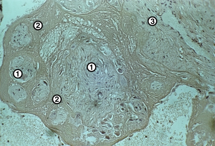 Рис. 4а). Микропрепарат дистрофически измененной плаценты при доношенной беременности: псевдоинфаркт, представленный дистрофически измененными ворсинами (1) и окружающим их фибриноидом (2), разрастание соединительной ткани в строме ворсины (3); ×250