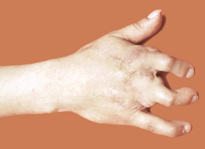 Рис. 2б). Результаты аутотрансплантации пальцев стопы на кисть при посттравматическом отсутствии II, III и IV пальцев правой кисти — через 1 год после раздельной пересадки вторых пальцев обеих стоп в позиции II и III пальцев кисти