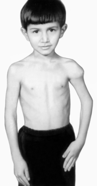 Рис. 1. Мальчик 8 лет с солитарной кистой кости: характерное вздутие плечевой кости