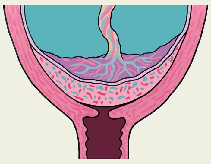 Рис. 1б). Схематическое изображение полного предлежания плаценты (на фронтальном разрезе матки)