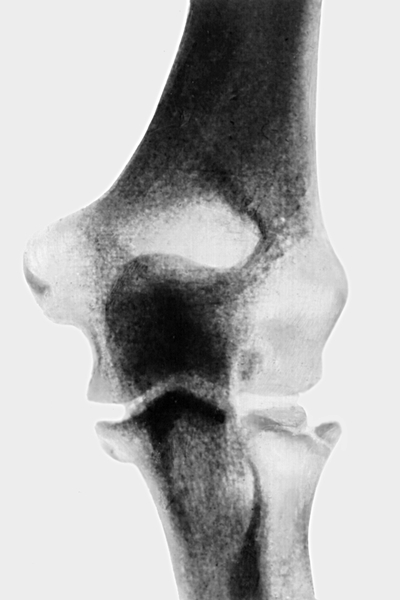 Рис. 11а). Рентгенограмма локтевого сустава при краевом фрагментарном переломе головки лучевой кости (переднезадняя проекция)