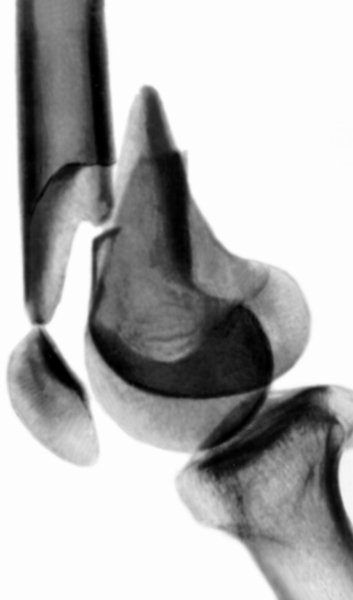 Рис. 22б). Рентгенограмма коленного сустава при переломе обоих мыщелков бедренной кости со смещением: боковая проекция