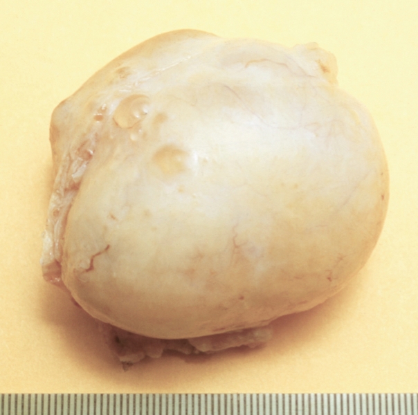 Рис. 7. Фолликулярная киста яичника (операционный препарат)
