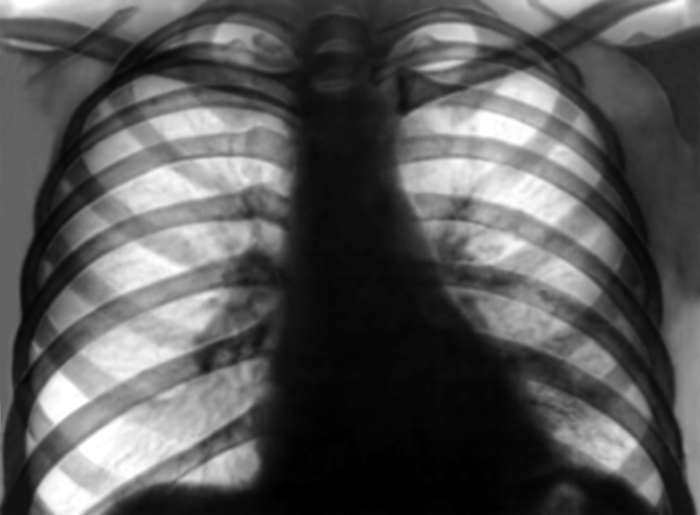 Рис. 11б). Рентгенограмма грудной клетки больного с декомпенсированным митральным стенозом: через 1 месяц после операции (почти полное исчезновение застоя в легких)