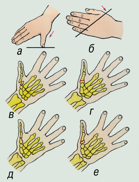 Рис. 3. Механизмы травмы и виды переломов I пястной кости: а — нагрузка на оси I пальца; б — удар по пястным костям; в — <a href=