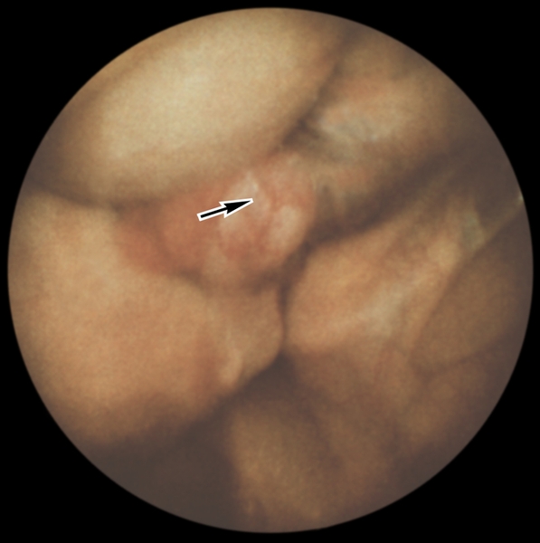 Лапароскопическая картина острого сальпингита: маточная труба (указана стрелкой) отечна и гиперемирована