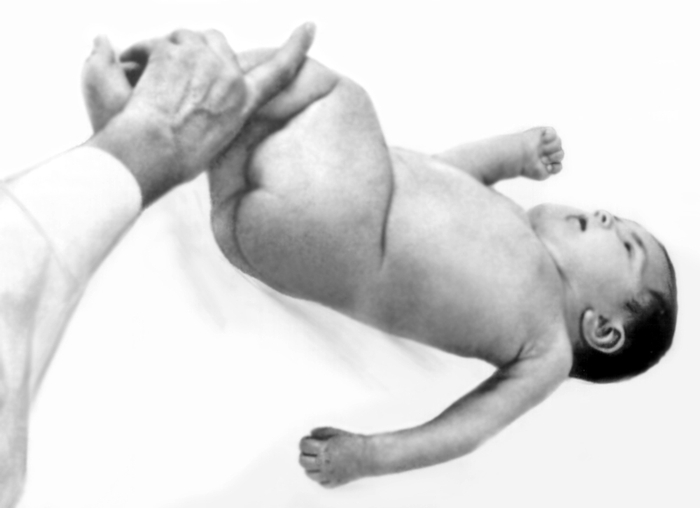 Рис. 4. Ребенок с нижним дистальным типом пареза плечевого сплетения (Дежерина — Клюмпке)