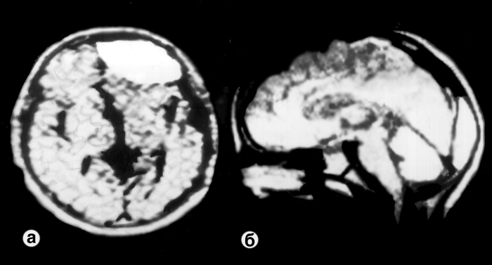 Рис. 3. Магнитно-резонансные томограммы при эпидуральной гематоме: а — в лобной доле (<a href=