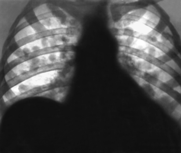 Рис. 10. Рентгенограмма органов грудной клетки в прямой проекции при очаговой пневмонии: в обоих легких видны нечетко очерченные затенения диаметром 1—2 см