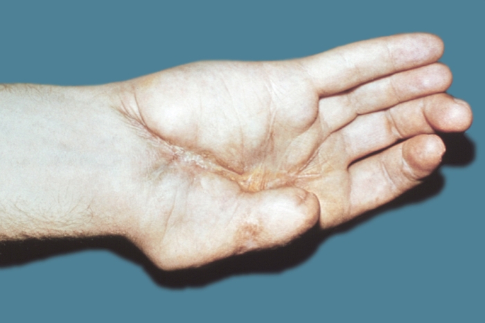 Рис. 3а). Кисть больного с посттравматической приводящей рубцовой контрактурой I пальца — до начала лечения