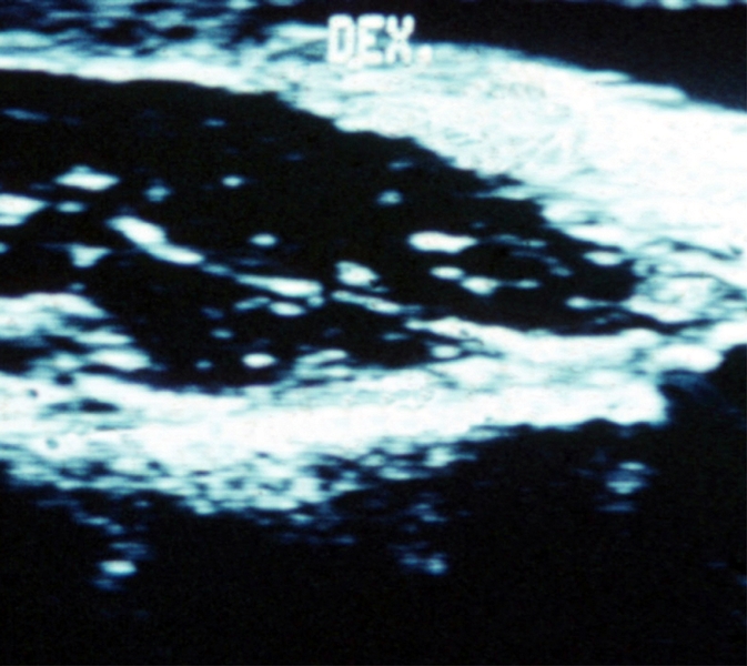 Рис. 2б). Ультрасонограмма клювовидно-акромиальных связок при частичном разрыве связки: виден фокус снижения эхогенности в месте частичного разрыва (указан стрелкой)