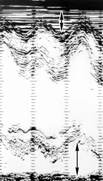 Рис. 24в). Эхокардиограмма больного с экссудативным перикардитом: изображение эхонегативного пространства за счет выпота в полость перикарда (толщина выпота отмечена двухполюсными стрелками) на одномерных эхокардиограммах, зарегистрированных на уровне нижней трети левого желудочка (эхопозитивные структуры представлены темными, а эхонегативные полости — светлыми полями)
