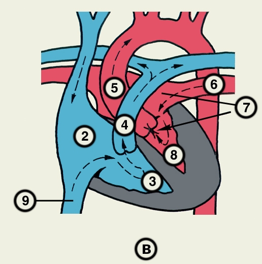 Рис. 23в). Схематическое изображение отдельных врожденных пороков сердца (направления кровотока обозначены пунктирными стрелками, локализация пороков — сплошными стрелками): аортальный стеноз; 2 — правое предсердие, 3 — правый желудочек, 4 — легочный ствол, 5 — аорта, 6 — легочная вена, 7 — левое предсердие, 8 — левый желудочек, 9 — нижняя полая вена