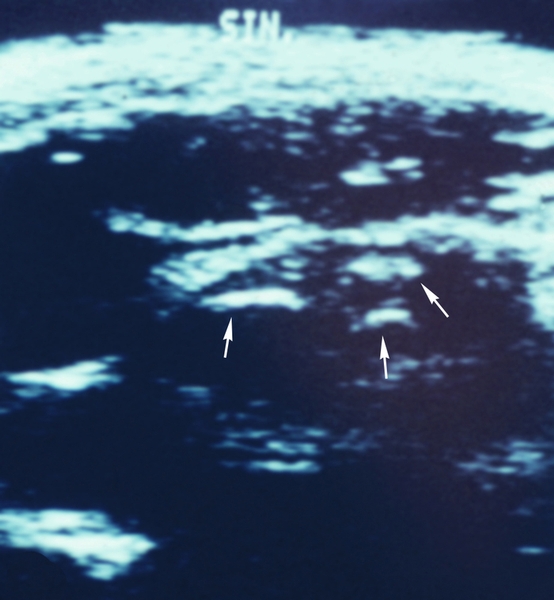 Рис. 15б). Ультрасонограмма передней поверхности левого плечевого сустава при хондроматозе левого плечевого сустава: эхогенность клювовидно-акромиальной <a href=