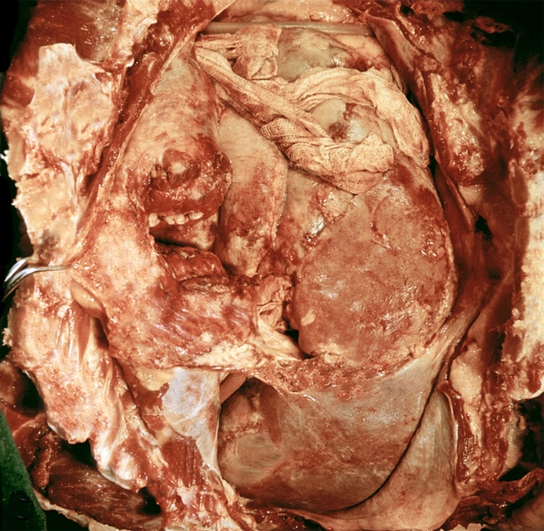 Рис. 1в). Макроскопическая картина вскрытой брюшной полости при гнойном перитоните: массивные фибринозно-гнойные наложения, спаяние петель кишечника между собой