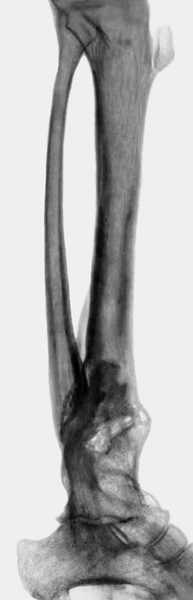 Рис. 4. Рентгенограмма костей голени больного с хроническим посттравматическим остеомиелитом, возникшим вследствие перелома в нижней трети большеберцовой кости