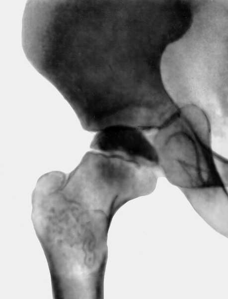 Рис. 3а). Рентгенограмма тазобедренного сустава (прямая проекция) при болезни Легга — Кальве — Пертеса: II стадия, импрессионный перелом головки бедренной кости, виден участок уплотнения кости