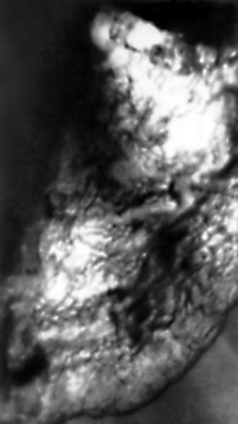 Рис. б). Рентгенологическая картина рельефа слизистой оболочки желудка при двойном контрастировании: грубонодулярный тип рельефа
