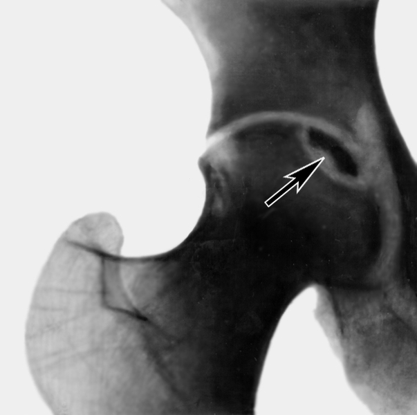 Рентгенограмма тазобедренного сустава при остеонекрозе головки бедренной кости: некротический участок (указан стрелкой) отделен <a href=