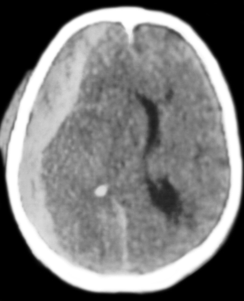 Рис. 1. Компьютерная томограмма головы при субдуральной гематоме после черепно-мозговой травмы