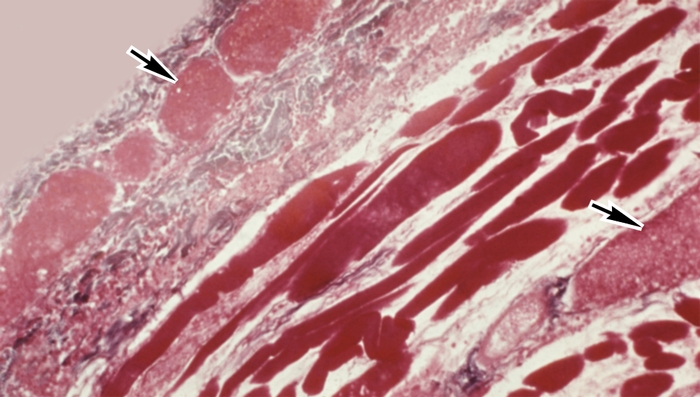 Рис. 2г). Микропрепараты париетальной и висцеральной брюшины при гнойном перитоните: гиперемия и тромбоз поверхностных и глубоких вен диафрагмы (указаны стрелками), окраска по Маллори; ×80