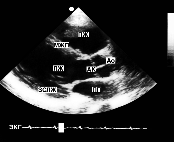 Рис. 4. Двухмерная эхокардиограмма с отображением сечения сердца в проекции длинной оси (справа — основание, слева — верхушка): видны полости обоих желудочков и левого предсердия, просвет продольного сечения аорты. На синхронно регистрируемой электрокардиограмме специальная отметка (в данном случае светлый прямоугольник) указывает на сердечный <a href=