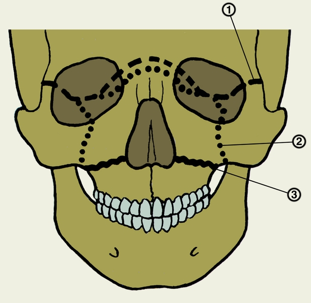 Рис. 6. Схематическое изображение локализации типичных переломов верхней челюсти: 1 — верхний перелом (указан пунктиром); 2 — средний перелом (указан точками); 3 — нижний перелом (указан сплошной линией)