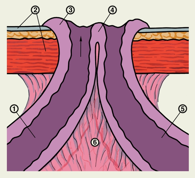Рис. 3б). Схематическое изображение губовидного свища — полный губовидный свищ: 1 — просвет приводящего отдела тонкой кишки; 2 — передняя <a href=