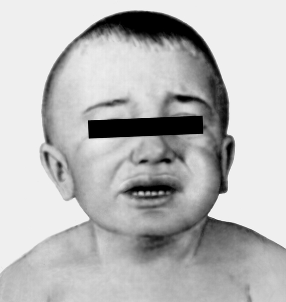 Рис. 3а). Синдром Гунтера у мальчика 2 лет — грубые черты лица, скафоцефалия