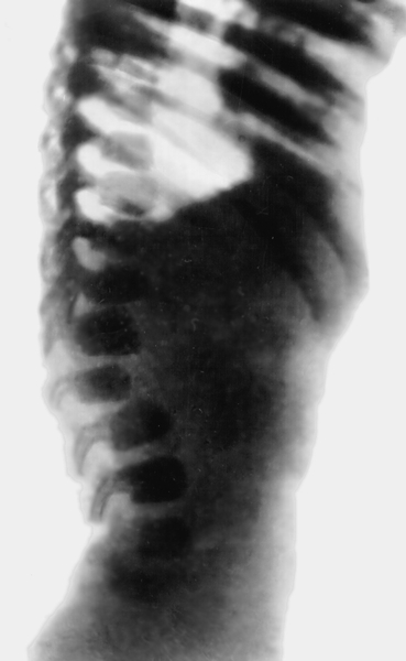 Рис. 8а). Рентгенологические признаки синдрома Марото — Лами — изменения позвоночника