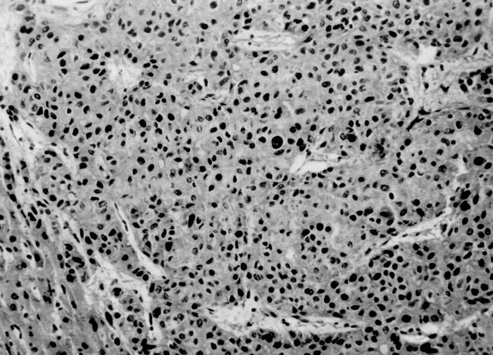 Рис. 8. Микропрепарат гепатоцеллюлярного рака: клетки опухоли имеют полигональную форму, складываются в балкоподобные, местами трабекулярные структуры; окраска гематоксилином и эозином; ×90