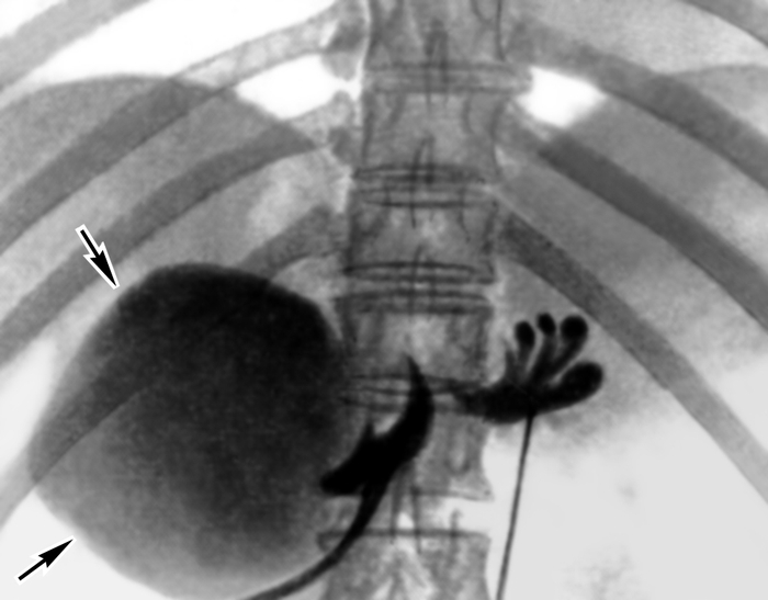 Рис. 9. Рентгенограмма поджелудочной железы, полученная при ретроградной панкреатохолангиографии: стрелками указана большая киста в головке поджелудочной железы