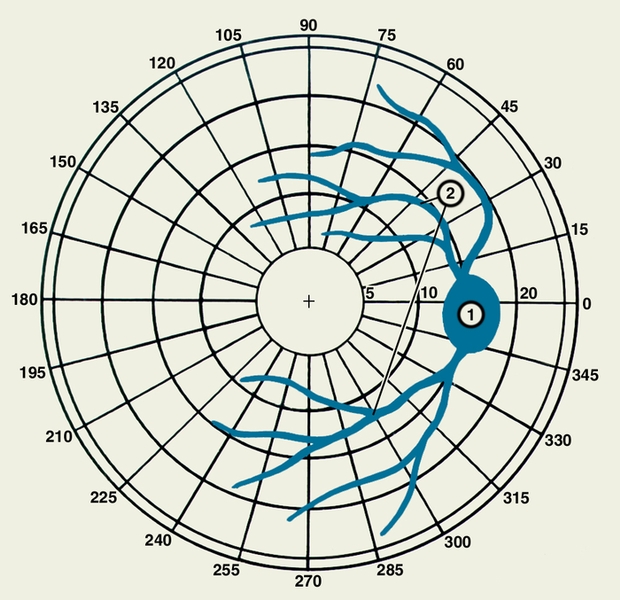 Рис. а). Изображение физиологических скотом на скотометрических схемах при исследовании поля зрения правого глаза (крестиком обозначена <a href=