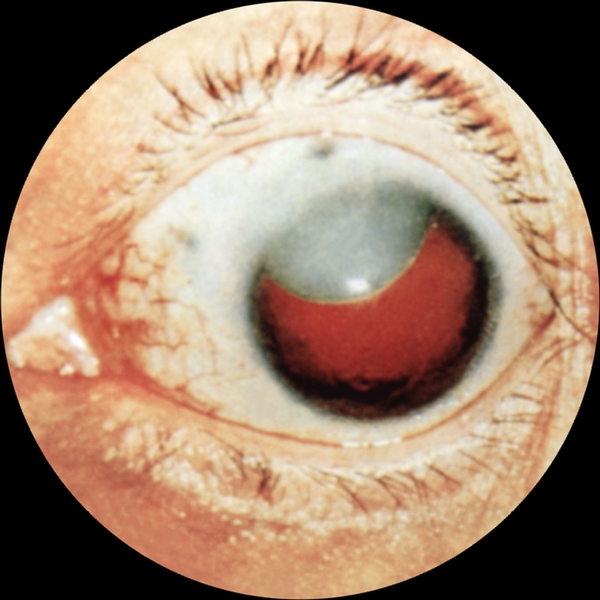 Рис. 1. Врожденная катаракта: виден край смещенного кверху и медиально мутного хрусталика; <a href=