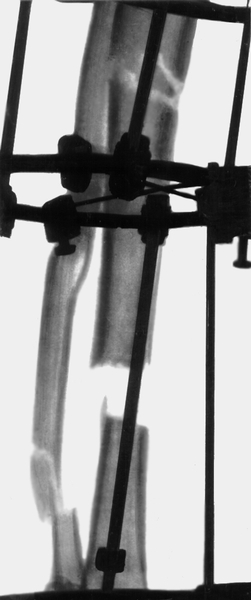 Рис. 22а). Рентгенограмма голени больного с хроническим посттравматическим остеомиелитом: произведена <a href=