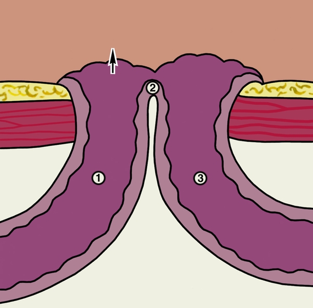 Рис. 1. Схематическое изображение губовидного кишечного свища (на разрезе): 1 — приводящая часть кишки (стрелкой показано направление продвижения кишечного содержимого); 2 — вершина шпоры (выпячивание задней стенки кишки); 3 — отводящая часть кишки