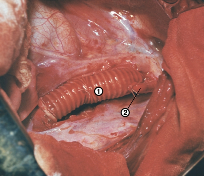 Рис. 31. Завершающий этап протезирования нисходящего отдела грудной аорты при сочетании ее коарктации с гипоплазией: в проксимальную часть синтетического протеза (1) имплантирована левая подключичная артерия (2)